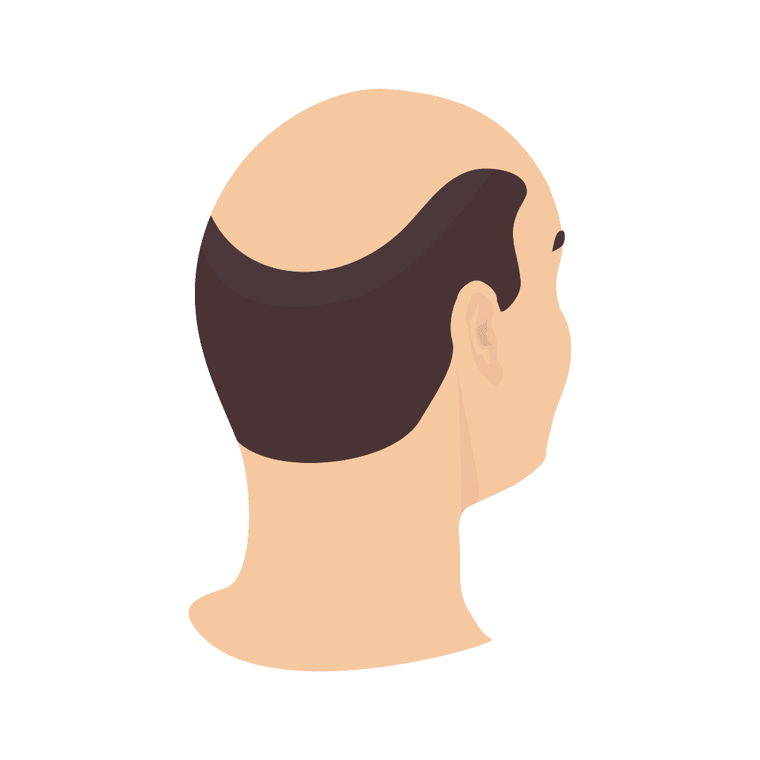 Alopecia and hair loss